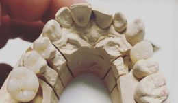 IPS Inlay mit Zirkon Abutment